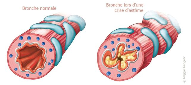 les symptômes et effets de l'asthme sur les bronches
